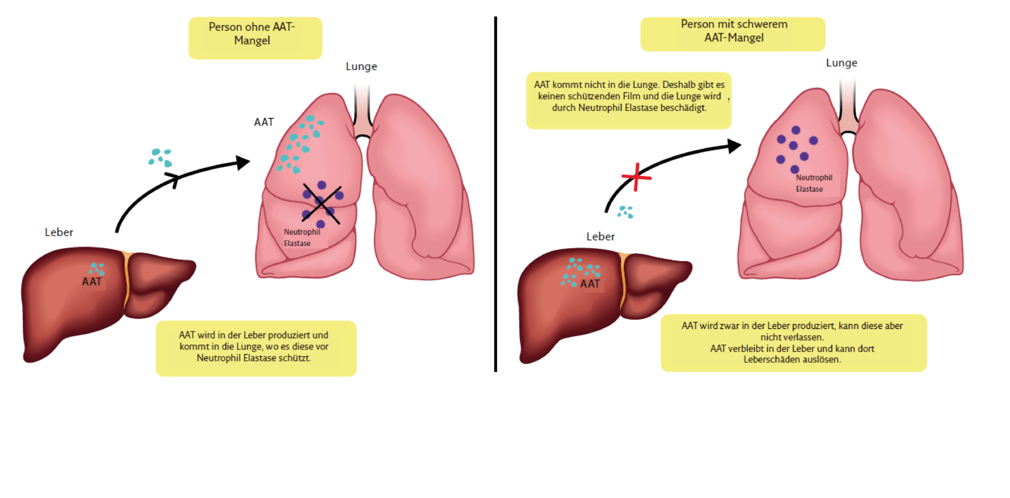 Alpha 1 Antitrypsin Mangel Leber europeanlung.org